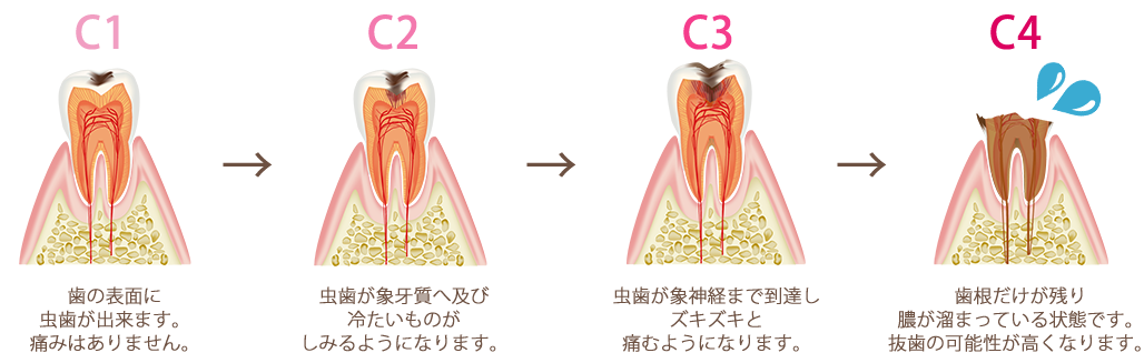 むし歯はこうして進行していきます。