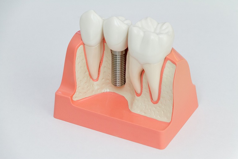 インプラント治療とは？