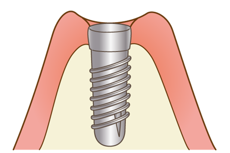 インプラント埋入