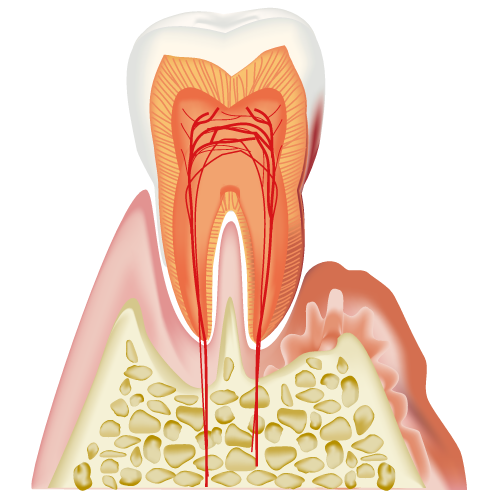 歯周炎(中度)